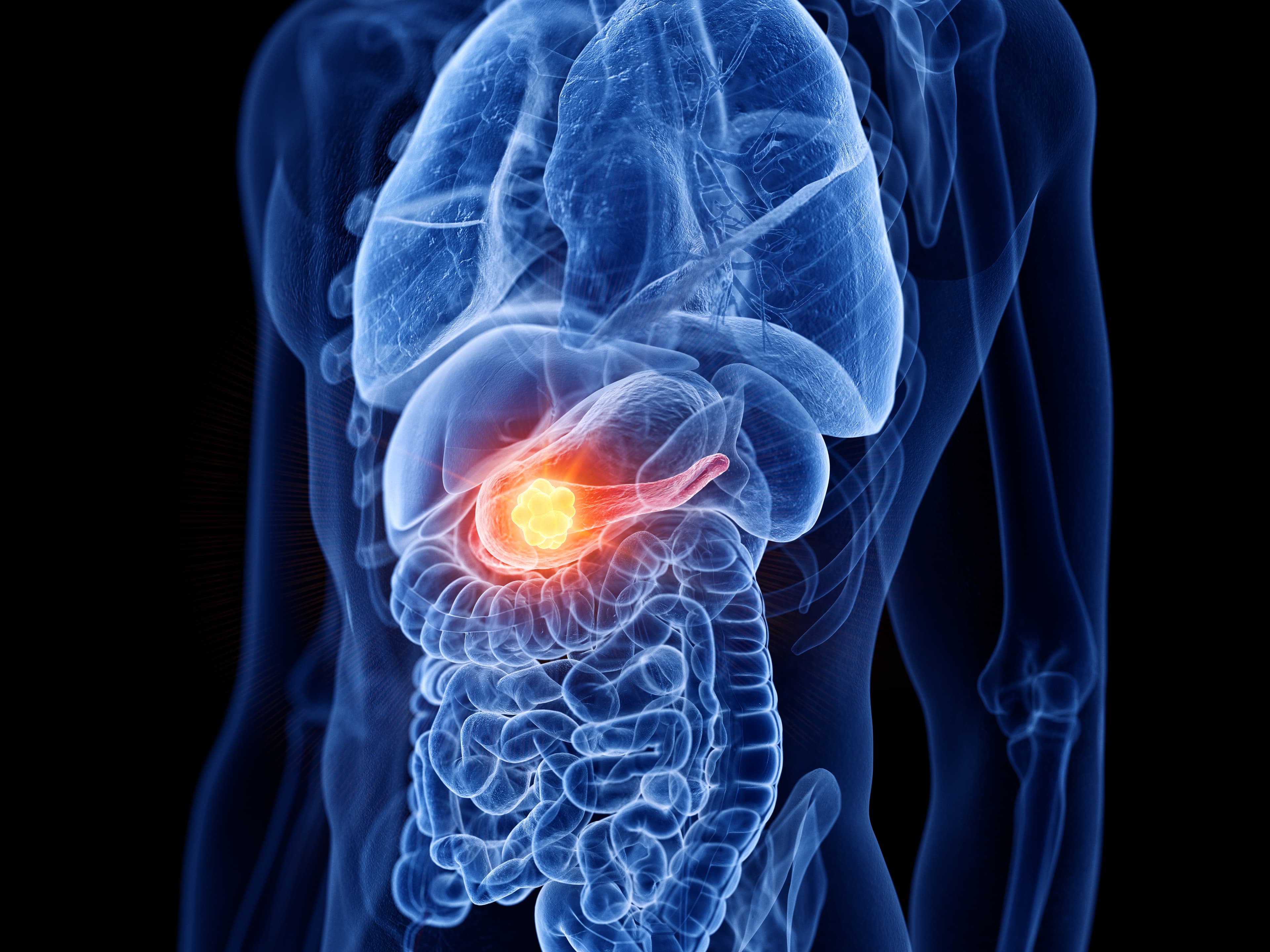 MoleCure Therapeutics — pancreatic cancer drug discovery.